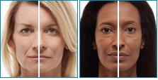 radiesse before and after pics